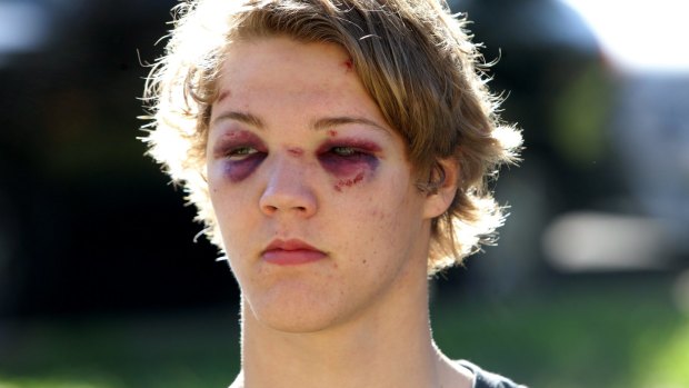 Jesse Chapman was brutally bashed by a man in the Strzelecki Lookout car park.