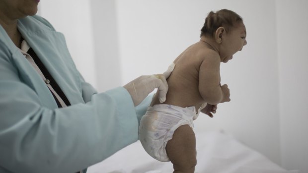A child, who is less then three months old and was born with microcephaly, in Brazil.