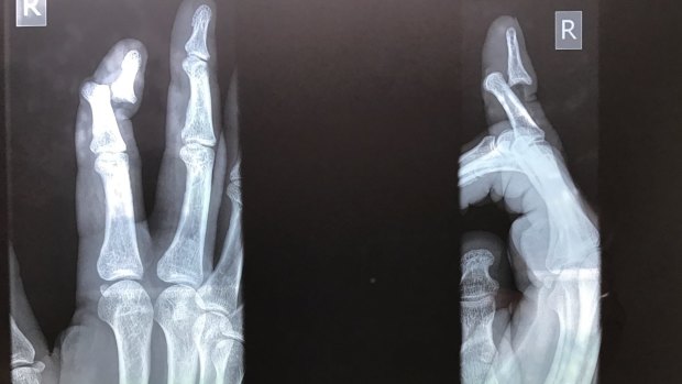 Bad break: X-rays show the fracture in Copeland's finger.