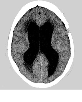 A CT scan of Gisela's blocked and swollen fluid chambers (the black X-shape) pressing brain tissue against the inside of her skull, which – without surgery – would cause her brain cells to progressively shut down. 