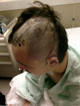 Tyler Horton sporting his post-surgery scar. 