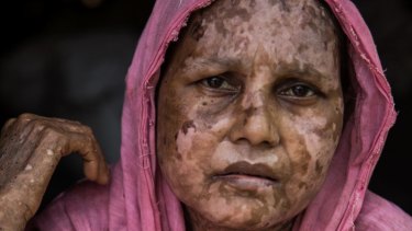 Shara Jahan fled to Bangladesh after the Myanmar military opened fire on men, women, and children and burned the houses. Her burns weren't treated for 10 days