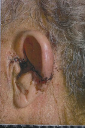 Damage to Ian Gore's ear.