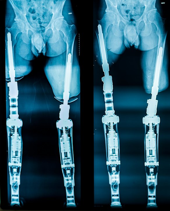 Behind the scenes: X-rays demonstrating osseointegration.