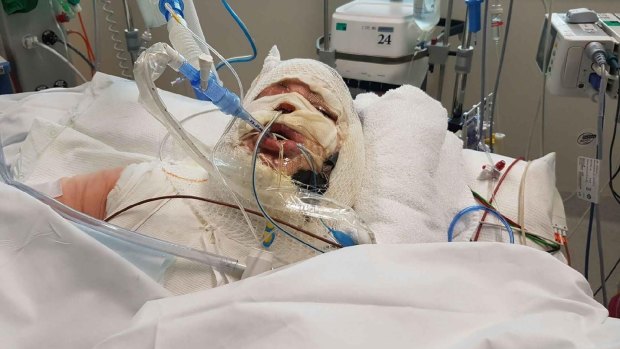 The 28-year-old victim in hospital after her ethanol burner exploded.