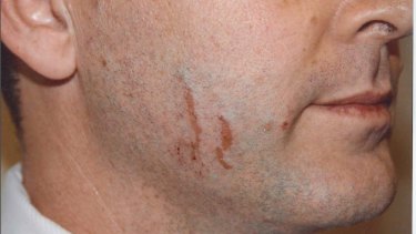 Police photographs of marks on Gerard Baden-Clay's face.