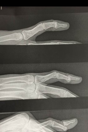 Ouch: Scans of Will Somerville's finger injury.