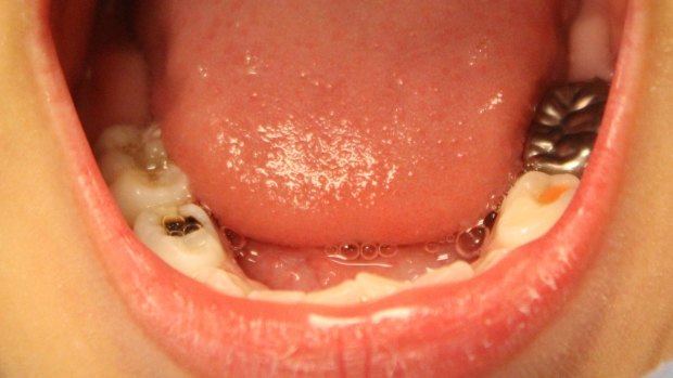 Dentists see tooth damage in very young children due to too many sugary drinks.
