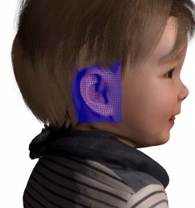 Modelling of a 3D-printed ear for a toddler with microtia.