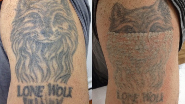 Boom in tattoo removal businesses
