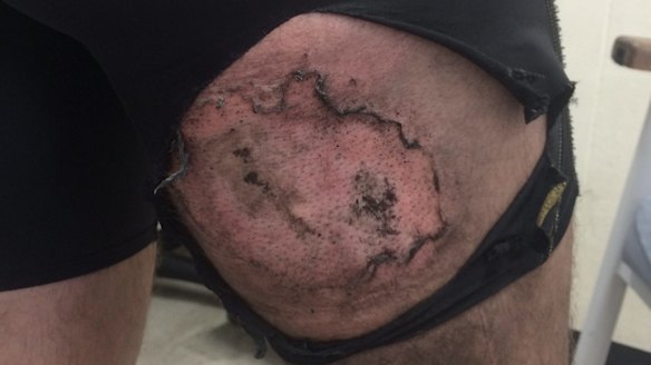 The burn suffered by Gareth Clear.