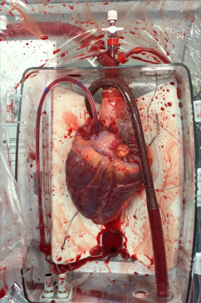 The donor heart reanimated and beating after circulatory death the ex vivo perfusion rig. 