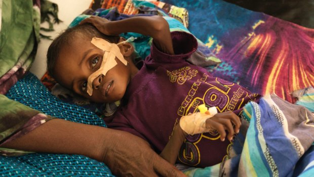 Niman Adan Gabush, 2, is a severe malnutrition case at Hargeisa Group Hospital.