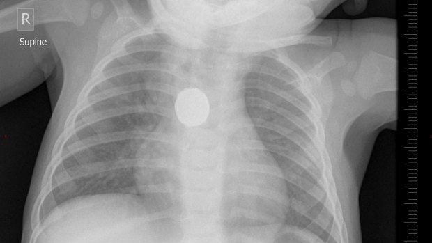 An x-ray showing a button battery lodged in the oesophagus of a 9-month-old boy.
