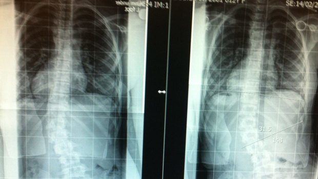 An x-ray showing the extent of the curvature of Ella's spine.