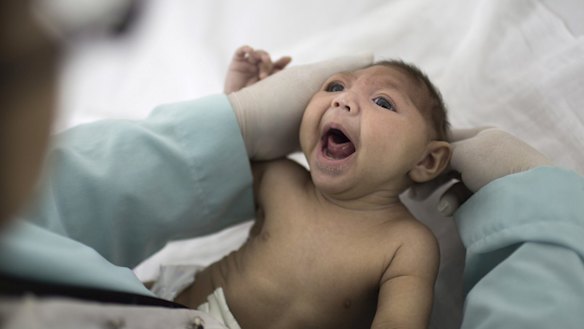 A baby with microcephaly, a defect linked to the Zika virus, in Brazil.
