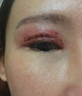 Ms Chen's eye after the botched surgery.