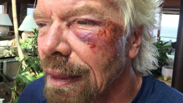 Branson suffered severe cuts to his knee, chin, shoulder and body. 