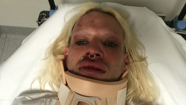 Danny Levi Bryce-Maurice says his nose was broken in a homophobic attack.