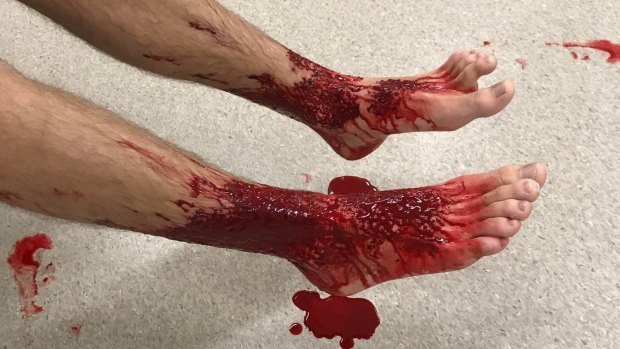 Teenager Sam Kanizay's bloody legs after possibly being bitten by something while bathing at Brighton.