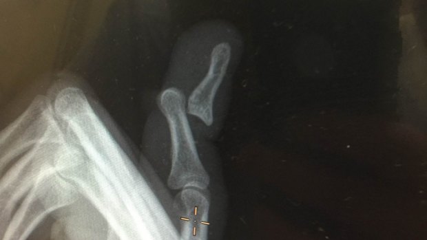 The X-ray from Jono Dean's dislocated finger.