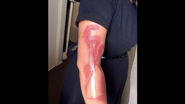 Melanie Tan Pelaez posted a picture online showing burns received after falling asleep on her charging iPhone 7.
