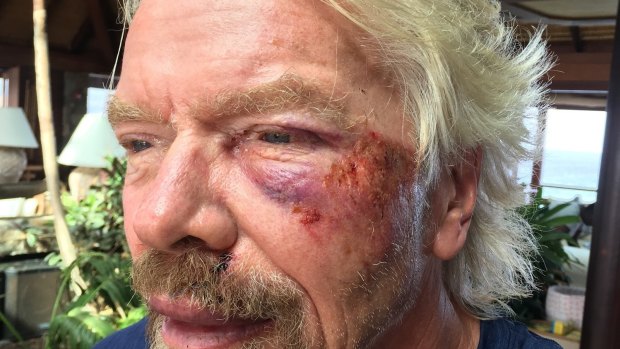 Richard Branson after he was involved in an accident when he crashed his bicycle on Virgin Gorda, one of the British Virgin Islands in the Caribbean. 