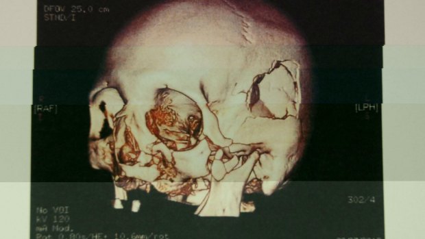 A CT scan of the victim's skull following the attack.  