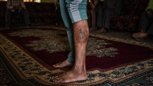 Imad shows a bullet wound on his left leg that he says he suffered during an ISIS mass execution he escaped. 