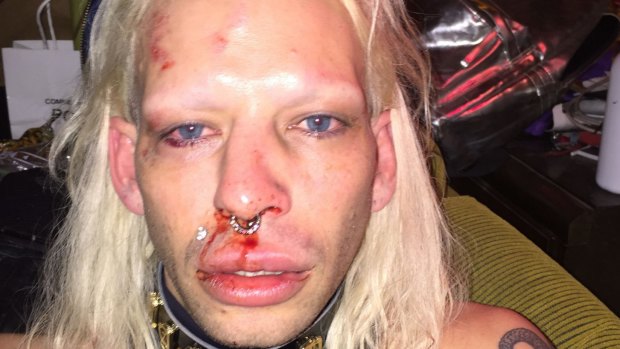Danny Levi Bryce-Maurice says he was attacked by four men in St Kilda and savagely beaten. 