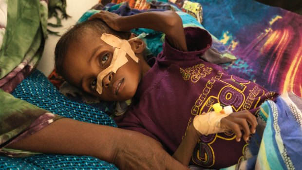 Niman Adan Gabush, 2, is a severe malnutrition case at Hargeisa Group Hospital in Somaliland.