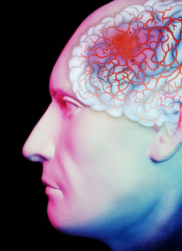 A stroke occurs when the blood supply to part of the brain is disturbed, causing a decrease in brain function. 