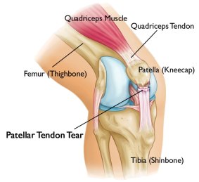 A diagram showing a patella tendon rupture where the ligament has torn off the patella bone. 