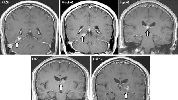 Slow journey: An MRI scan of the tapeworm moving, over a period of four years, from the left to right hemisphere of the man's brain.