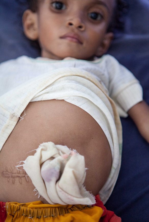 Children still remain malnourished in East Timor.