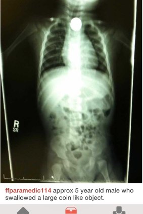 An x-ray of a young male patient who swallowed a coin.