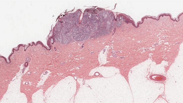 A melanoma under the microscope.
