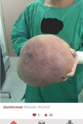 A tumour removed from a patient.
