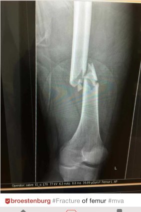X-ray of a fractured femur.