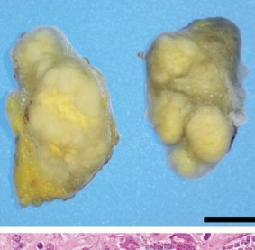A biopsy specimen from a cervical lymph node containing firm, solid masses.