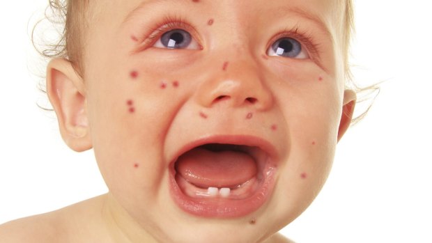 A boy with measles.