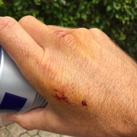 Whincup's hand post-bite.