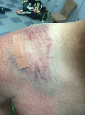 Cricket Australia tweeted a picture of Haddin’s injured shoulder.