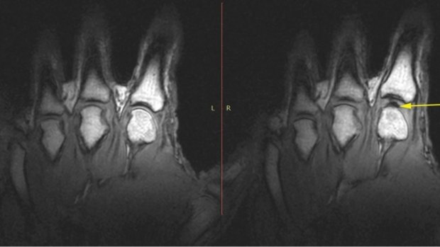 Researchers have used MRI to see what happens when a knuckle cracks.