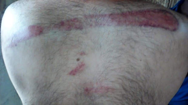 Photos distributed by the Refugee Action Coalition show injuries sustained by Iranian asylum seeker, Mohammed. 