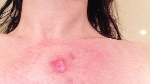 Burns suffered by one Thermomix user after her machine malfunctioned.