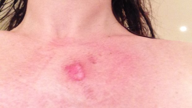 Burns suffered by one Thermomix user after her machine malfunctioned.