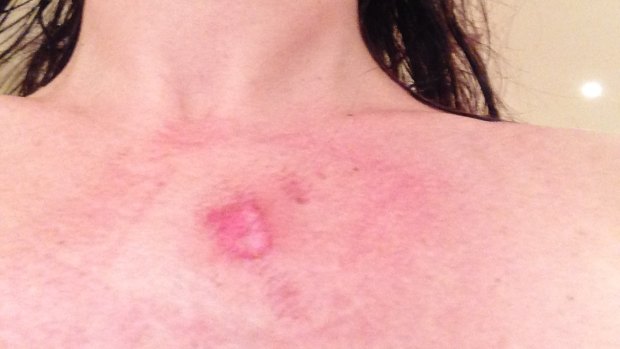 Burns suffered by one Thermomix user after her machine malfunctioned.