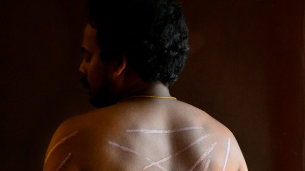 Tamil asylum seeker shows his wounds from being tortured.