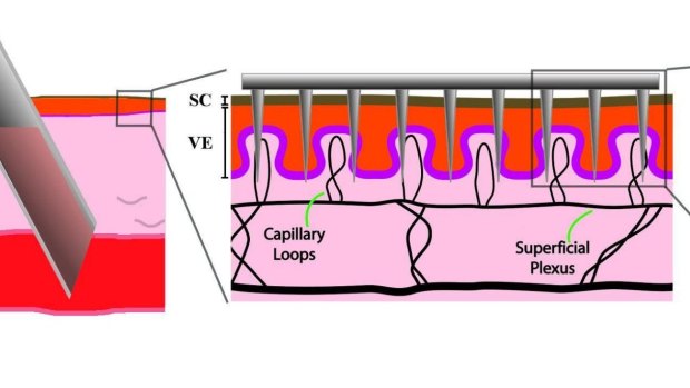 Standard needles (left) penetrate through skin and subcutaneous tissue to withdraw blood; microneedle arrays target the tiny blood vessels in the upper layers of the skin. 